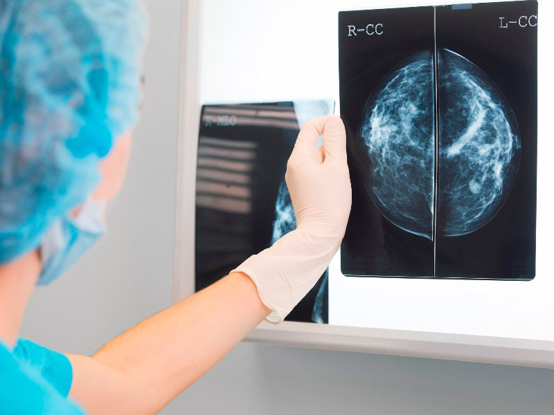 ماموگرافی سینه