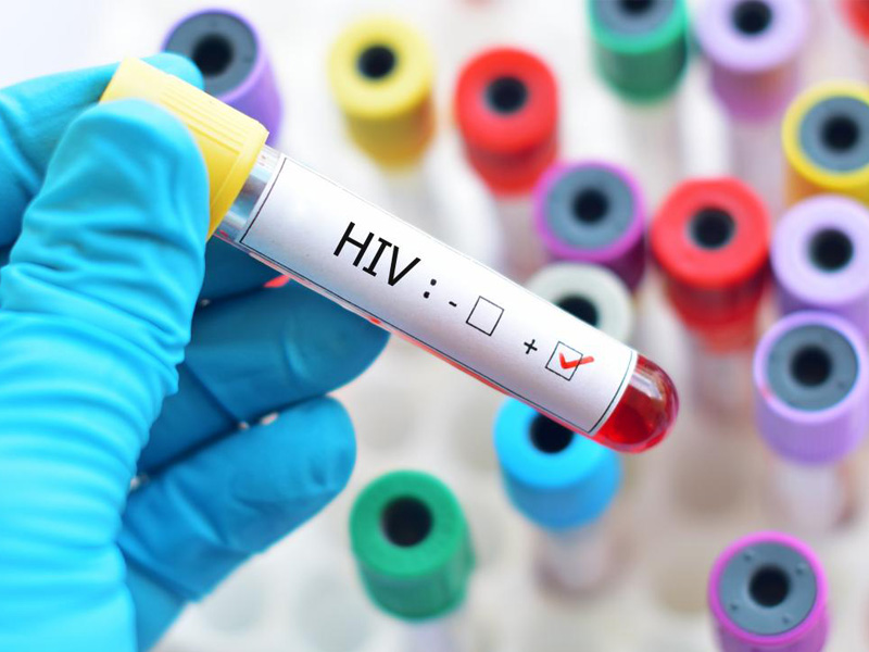 بیماری ایدز چیست؟ راه های انتقال ویروس HIV و روش های تشخیصی