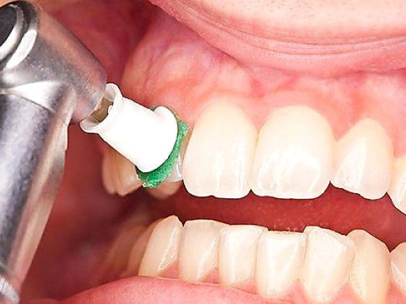 جرم گیری دندان توسط دندانپزشک
